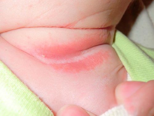Чим лікувати пітницю на шиї у немовляти? » журнал здоров'я iHealth 