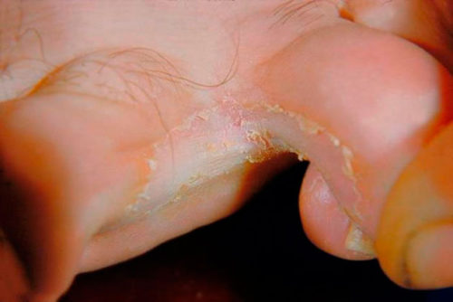 Як позбутися від опрілостей між пальцями ніг? » журнал здоров'я iHealth 