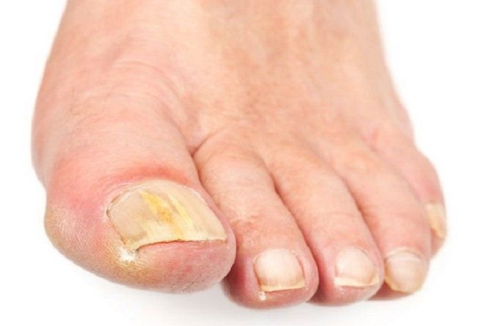 Заходи профілактики грибка стопи і нігтів » журнал здоров'я iHealth 