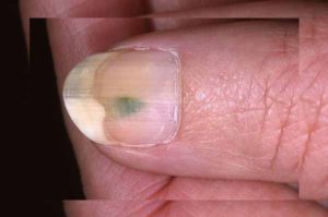 Як розпізнати грибок нігтів на ногах? » журнал здоров'я iHealth 1