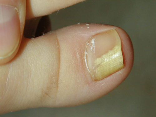 Як вилікувати грибок нігтів в домашніх умовах? » журнал здоров'я iHealth 