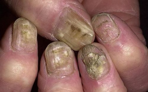 Лікування грибка нігтів на руках народними засобами » журнал здоров'я iHealth 