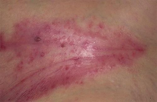 Лечение опрелостей в паху у взрослых