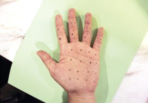 Инъекции ботокса