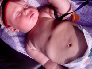 Потоотделение как признак заболевания