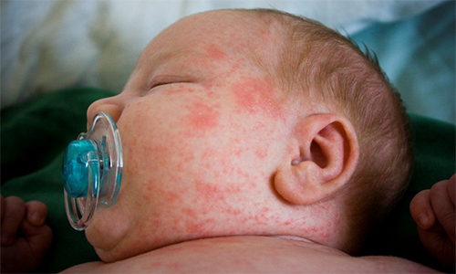 Потница у грудничков