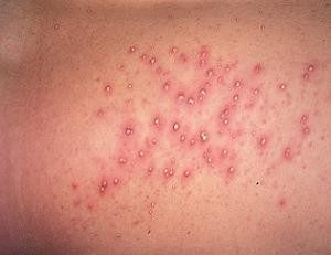 Папулезная потница