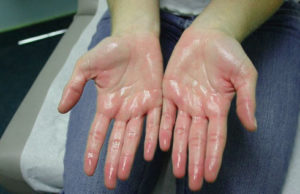 разные типы гипергидроза