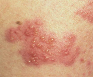 Папулезная потница