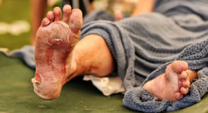 Фурацилин противопоказан