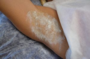 Лечение повышенного потоотделения