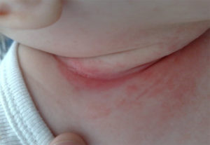 Опрелость у ребенка