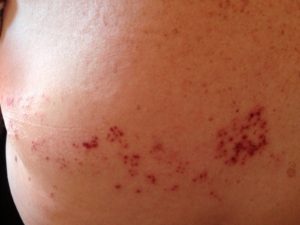 Симптоматика и стадии развития патологии