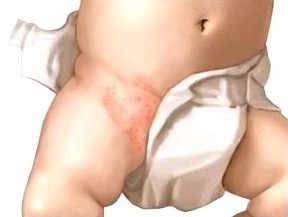 Опрелость у новорожденного