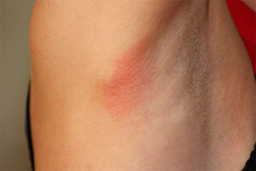 Опрелости под мышками у взрослых лечение