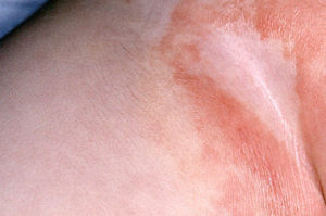 наличие опрелостей