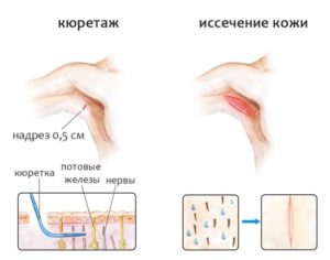 Хирургическое вмешательство