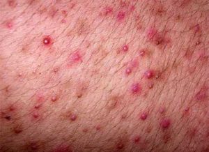 Папулёзная потница