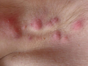 Гидраденит