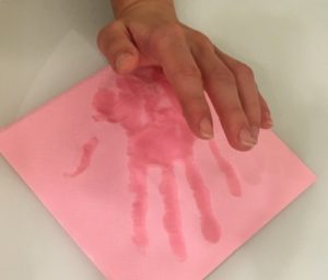 Идиопатический гипергидроз