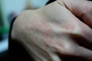 Симптоматика гипергидроза