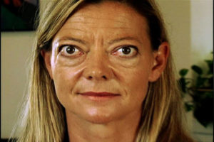 Гипертиреоз