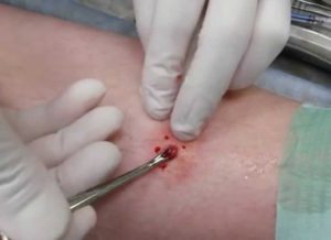 Что будет если не лечить