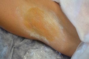 проводят пробу Минора