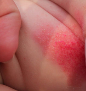 Появление гнойничковой сыпи