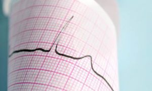 электрокардиограмма