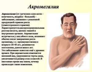 Акромегалия