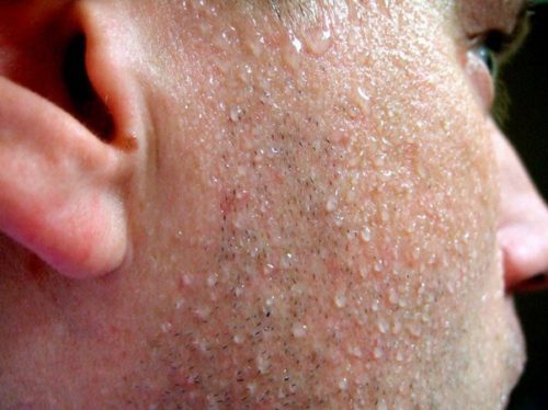 Генерализованный гипергидроз