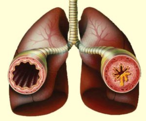 бронхоспазм