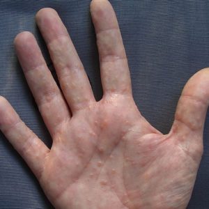 Потница на руках