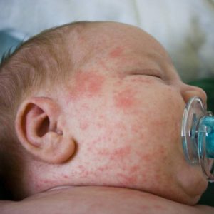 Потничка на голове у новорожденного