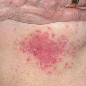 Причины потницы под грудью