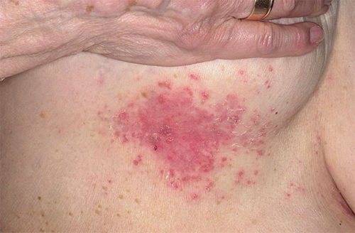 Причины потницы под грудью