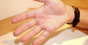 Гипергидроз