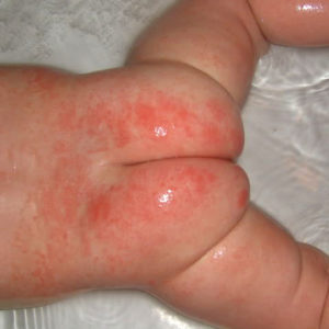 Противопоказания для применения цинковой мази