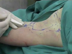 Особенности симпатэктомии