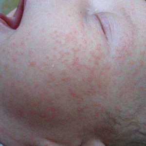 Чешется ли потница у детей