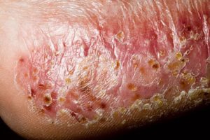 Виды заболевания