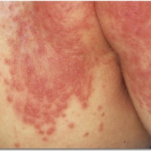 Эритематозная опрелость