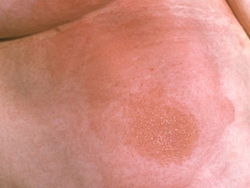 Эритематозная опрелость