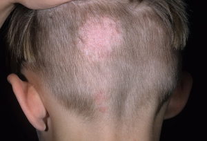 Стригущий лишай