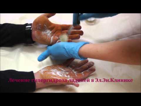 Гипергидроз ладоней – лечение инъекциями ботокса