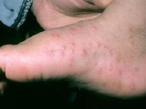 Микозы сопровождаются волдырями