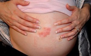 Виды потницы