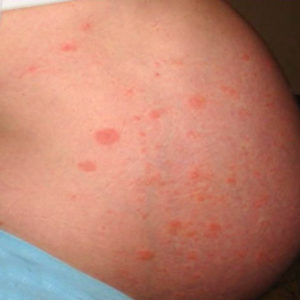 Потница при беременности