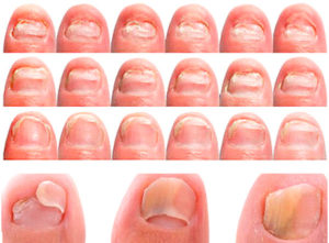 Что такое грибок